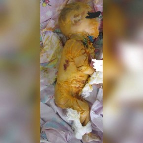 Осторожно. Жесткие кадры. В Бурятии зафиксирован трагический случай: новорождённый с редчайшим наследственным заболеванием — ихтиозом Арлекина — прожил всего 11 дней