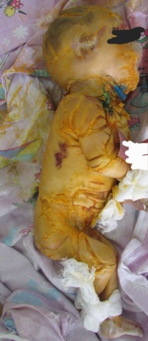 В Бурятии показали ребёнка, рождённого от родных брата и сестры