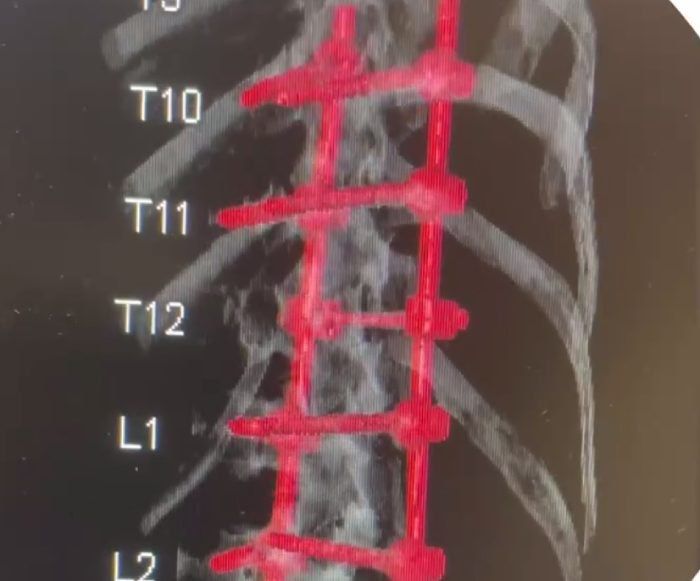 Падение с высоты своего роста обернулось для жителя Бурятии серьёзной операцией