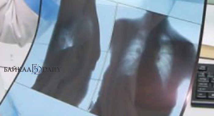 Жительнице Бурятии из-за ошибки врача частной клиники удалили часть лёгкого