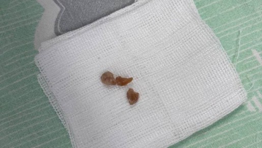 Годовалый малыш едва не погиб из-за конфеты в Иркутске