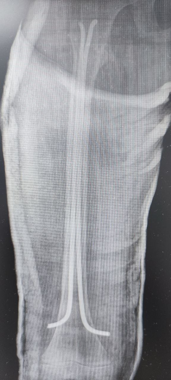 7-летний ребенок сломал бедро, катаясь на ватрушке