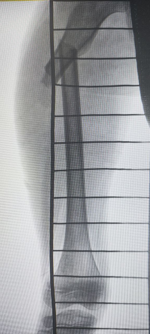 7-летний ребенок сломал бедро, катаясь на ватрушке 7-летний ребенок сломал бедро, катаясь на ватрушке