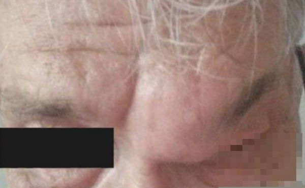 В Бурятии мужчину с огромной кистой на лбу спасли от смерти