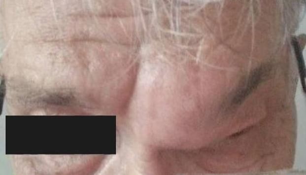 Начала проникать в мозг: врачи спасли от смерти пациента с кистой на лбу