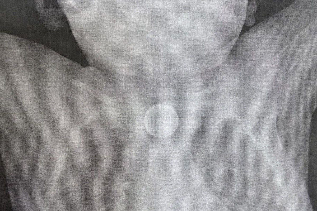 Врачи ДРКБ в Бурятии спасли годовалого ребенка, проглотившего батарейку и монету