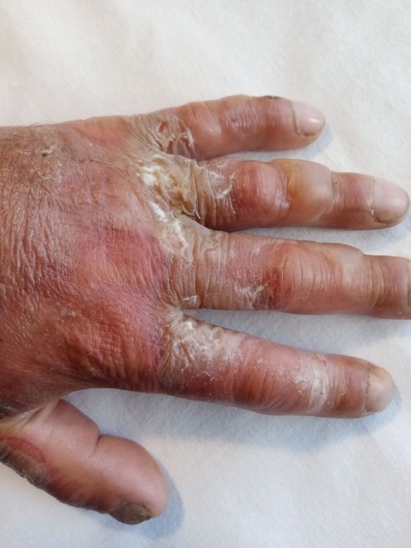 В Бурятии мужчина получил ожоги на пожаре в зимовье