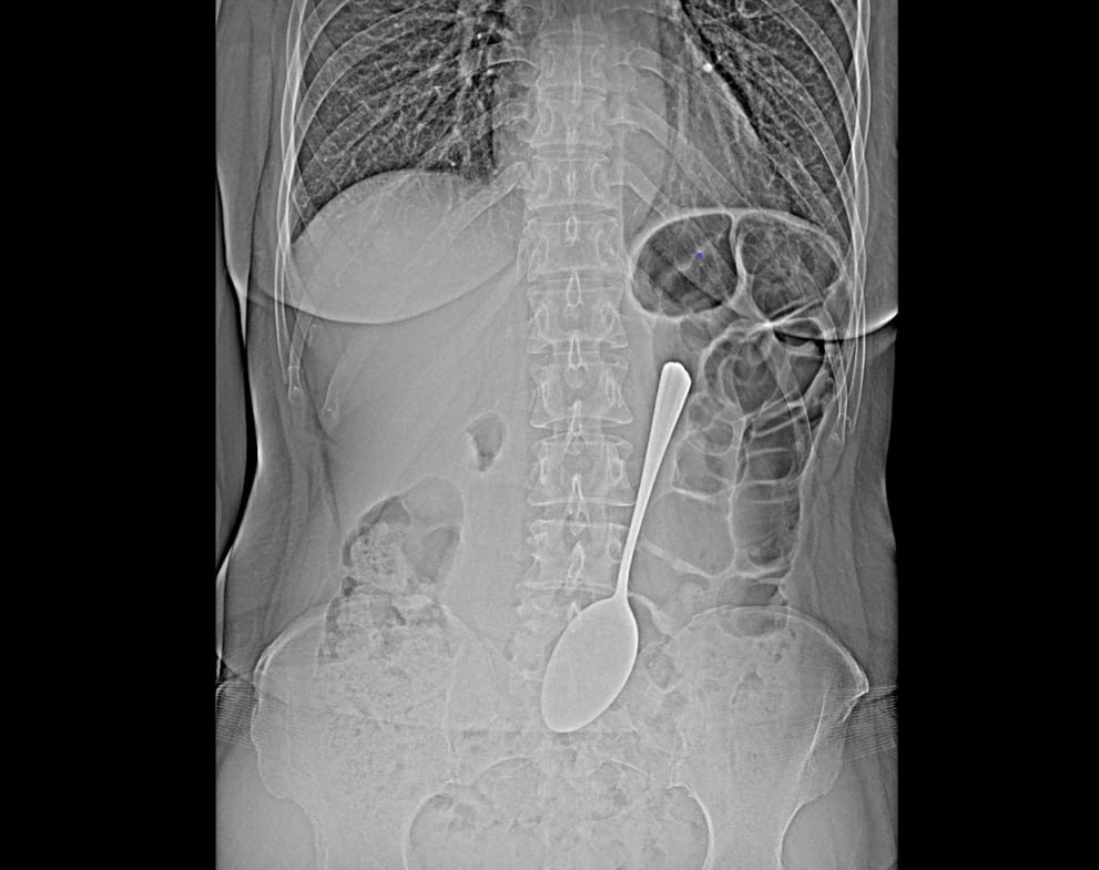 Врачи БСМП в Улан-Удэ извлекли из желудка пациентки столовую ложку Врачи БСМП в Улан-Удэ извлекли из желудка пациентки столовую ложку