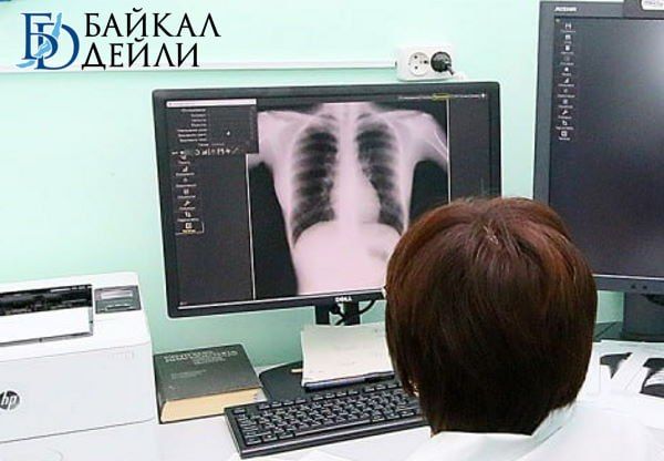 В Бурятии активный туберкулёз за год нашли почти у 300 человек