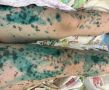 Редкая смертельная аллергия маскировалась под обычную простуду